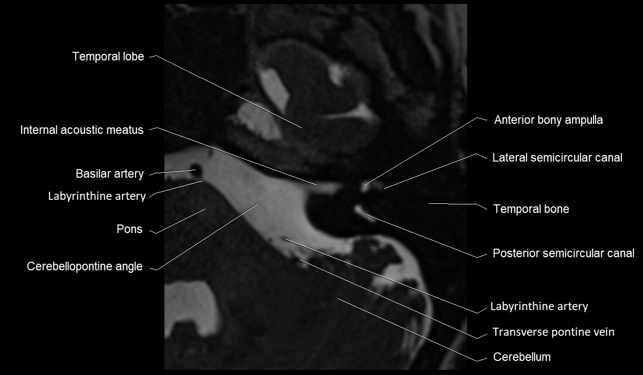Internal auditory canal (IAC) axial cross sectional anatomy image 18.webp